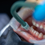 Sângerarea gingivală